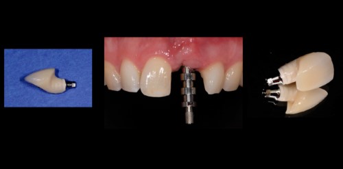 hoice of type of fixation: screw-retained vs. cemented reconstructions